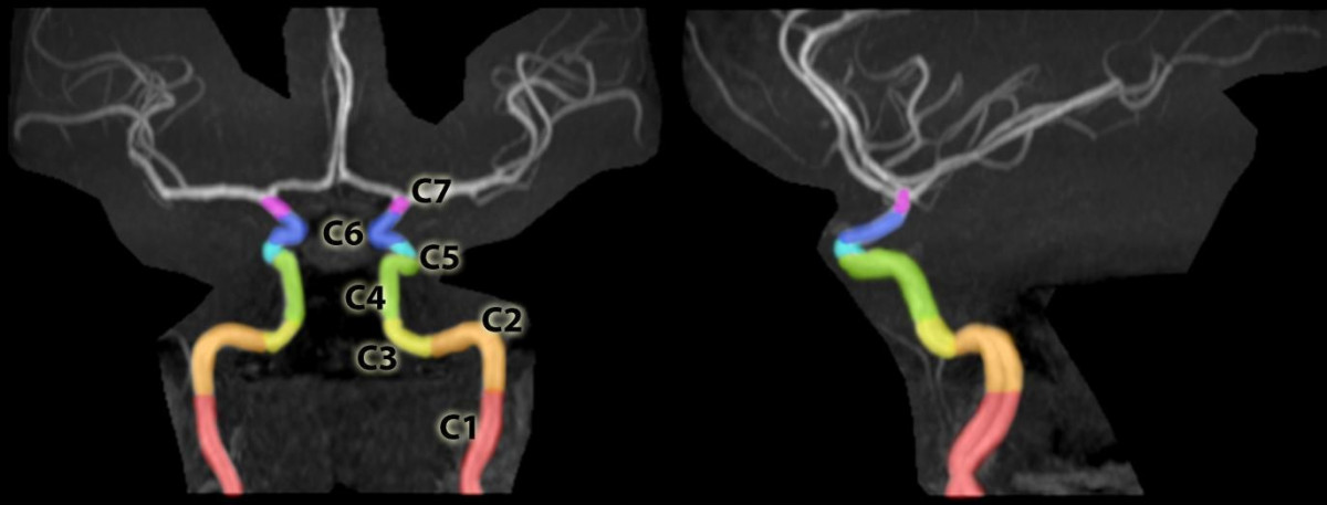 internal carotid artery