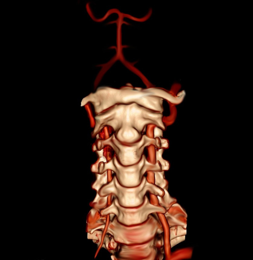 Vertebral artery