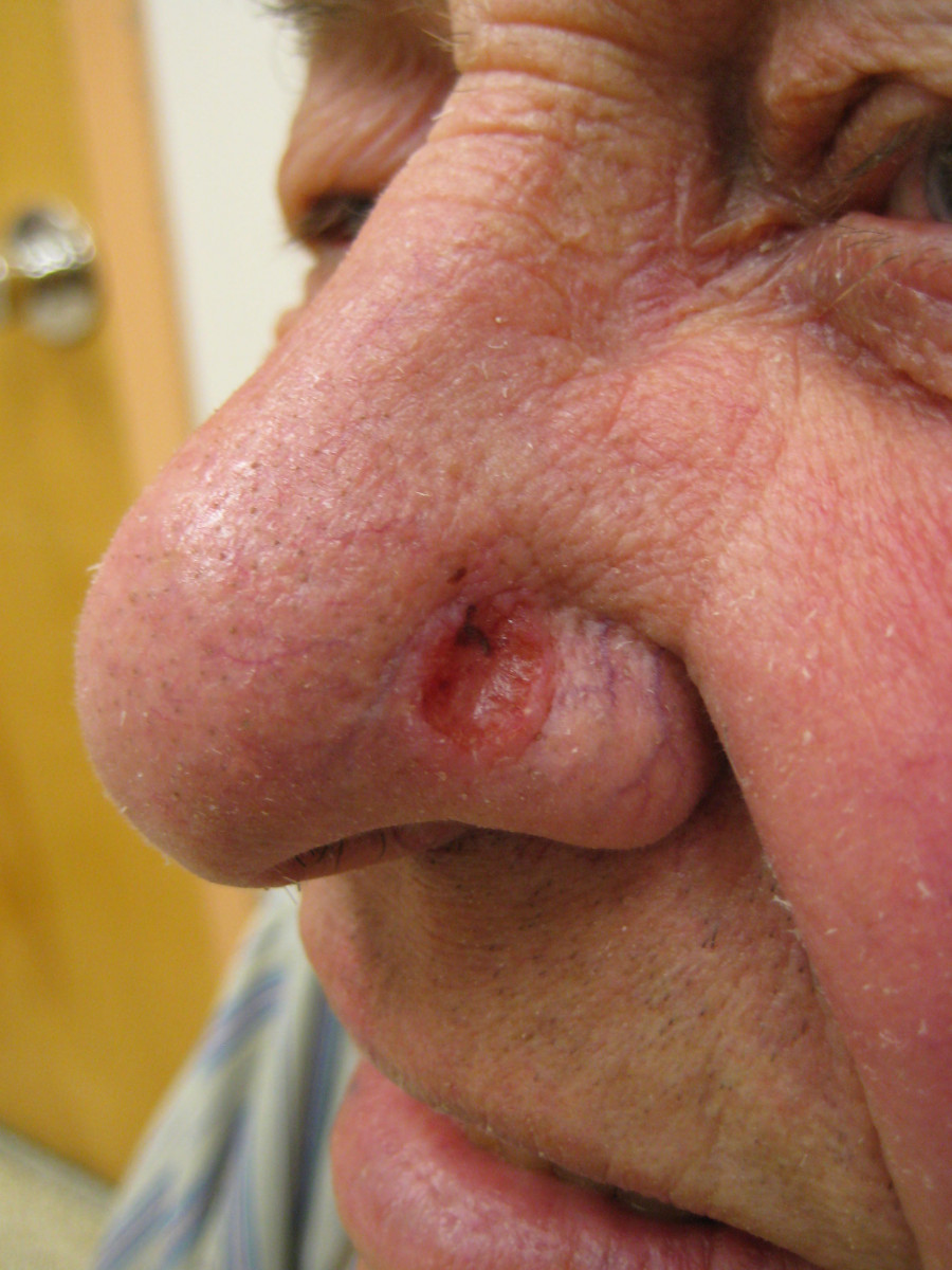 Basal cell carcinoma