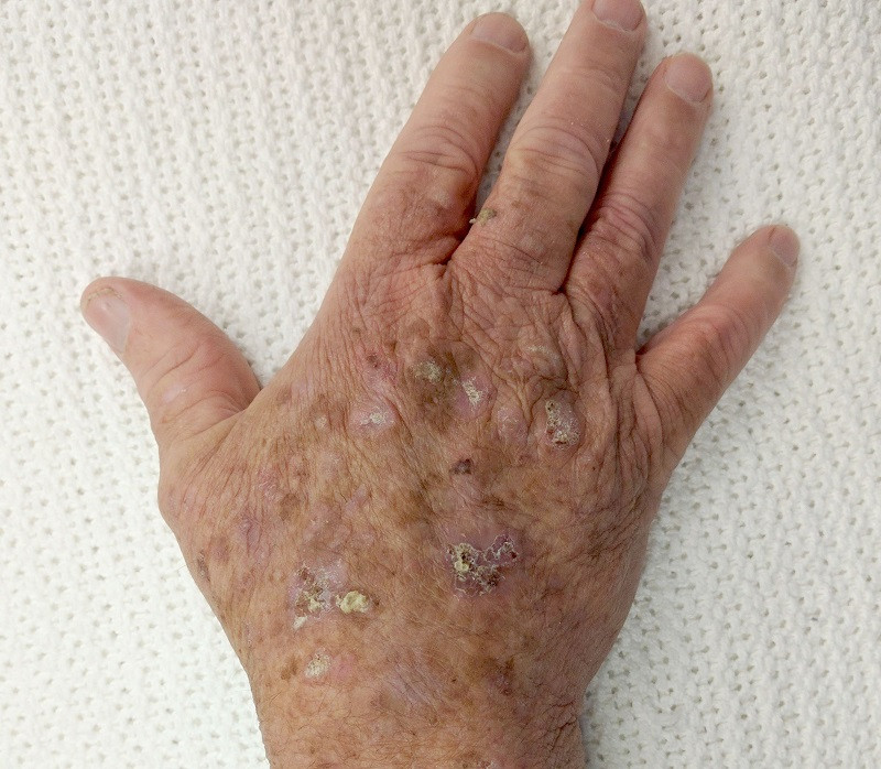 Actinic keratosis