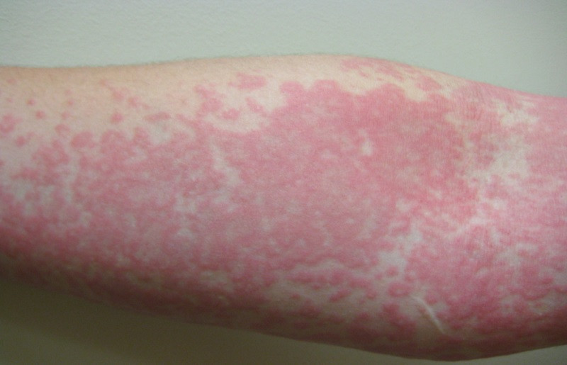 Urticaria