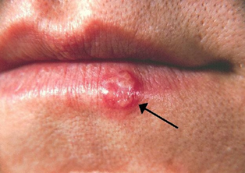 Herpes labialis