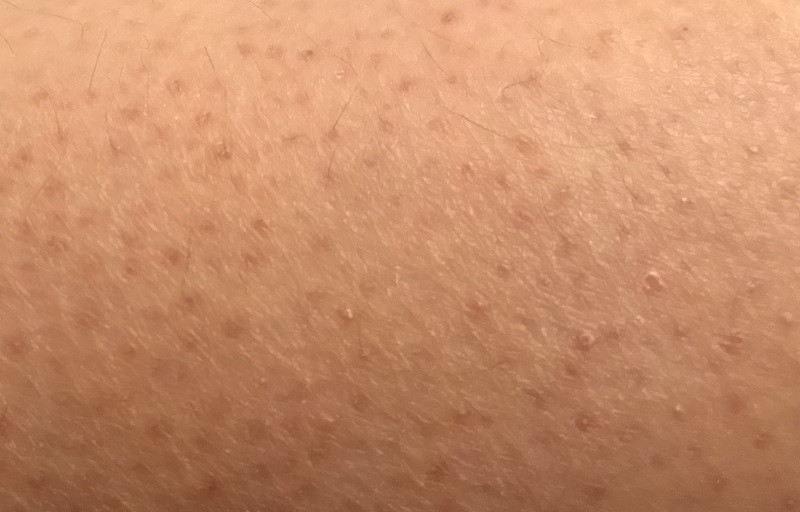 Keratosis pilaris