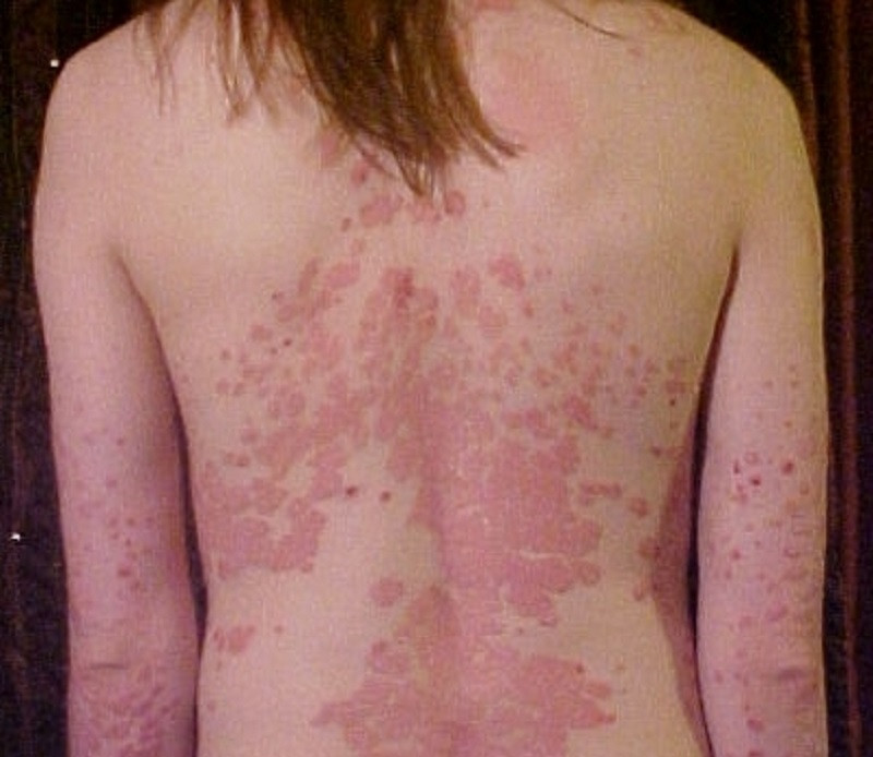 Psoriasis