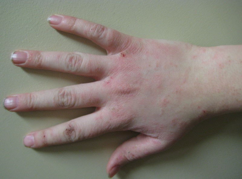 Eczema