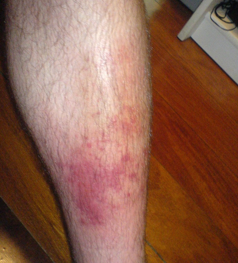 Cellulitis due to infection