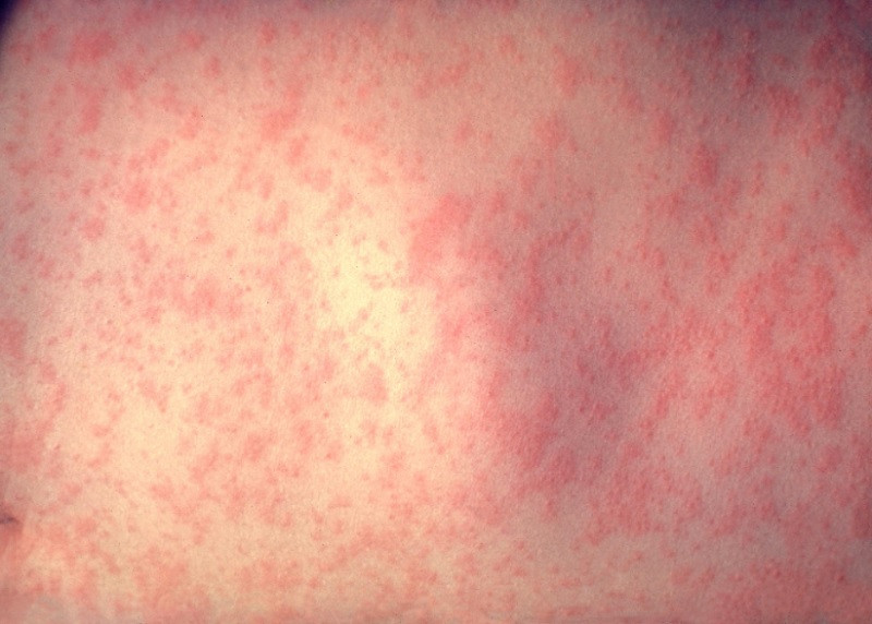 Measles