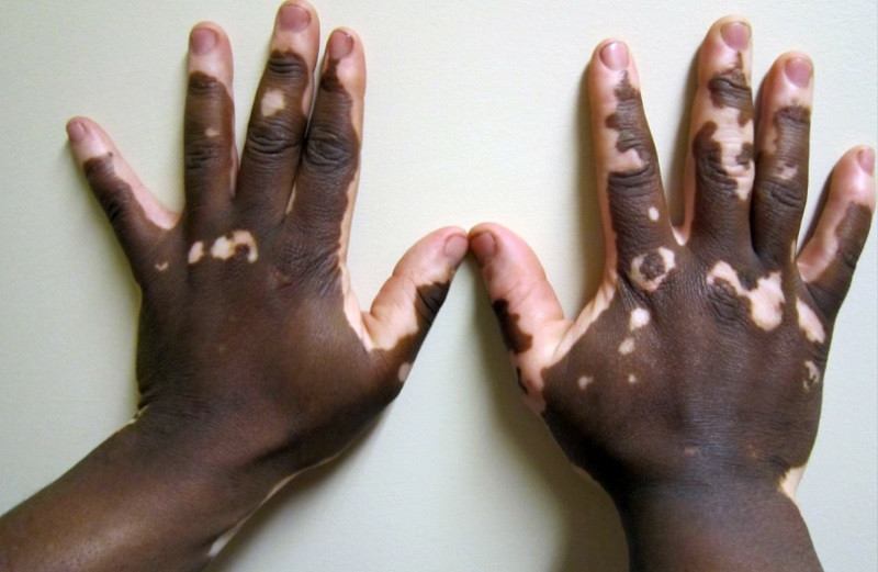 Vitiligo