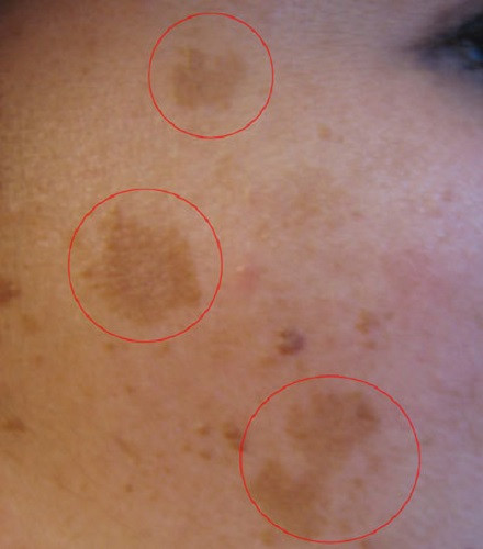 Melasma