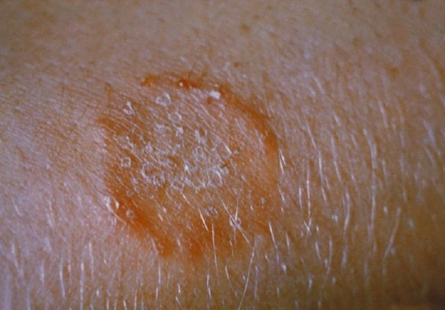 Ringworm of the body