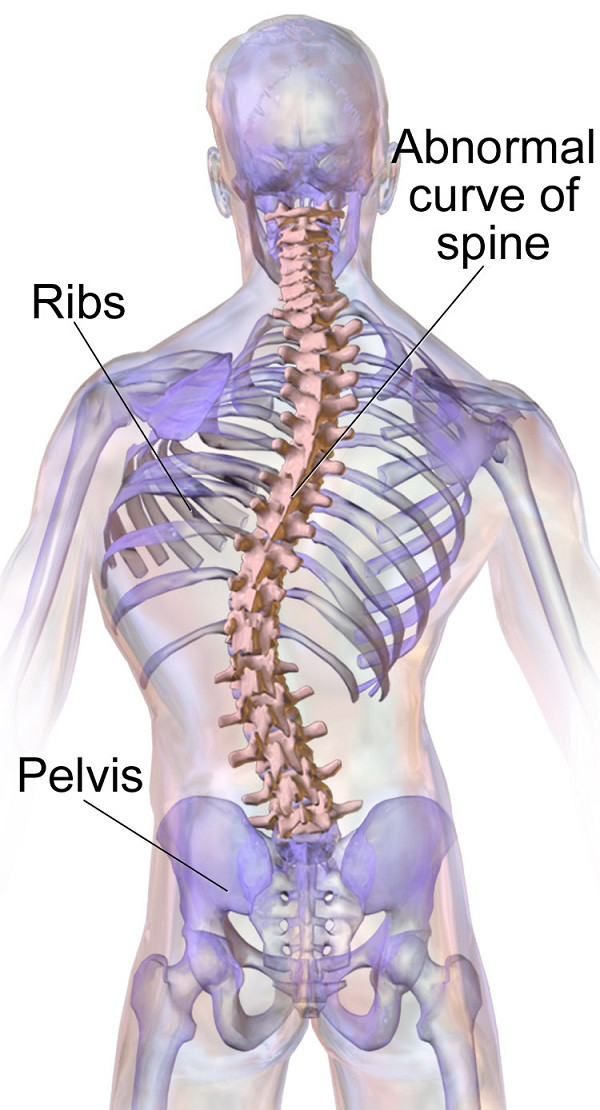 Scoliosis