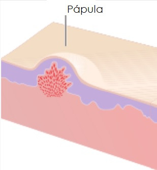 Papule