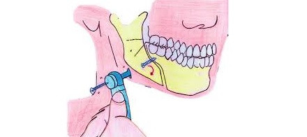 bicortical screws