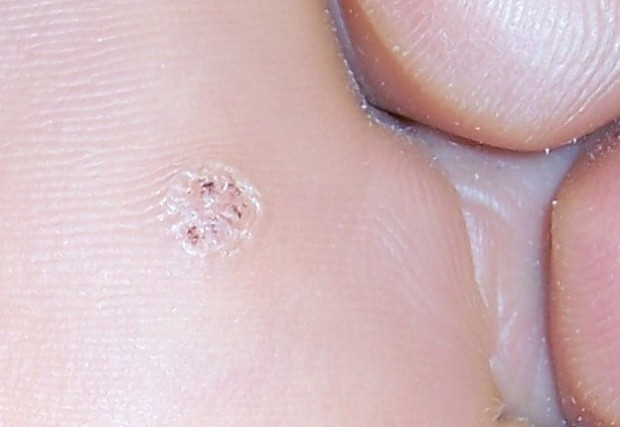 Plantar warts