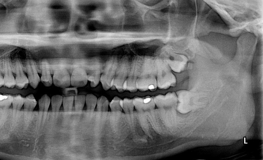 Wisdom teeth