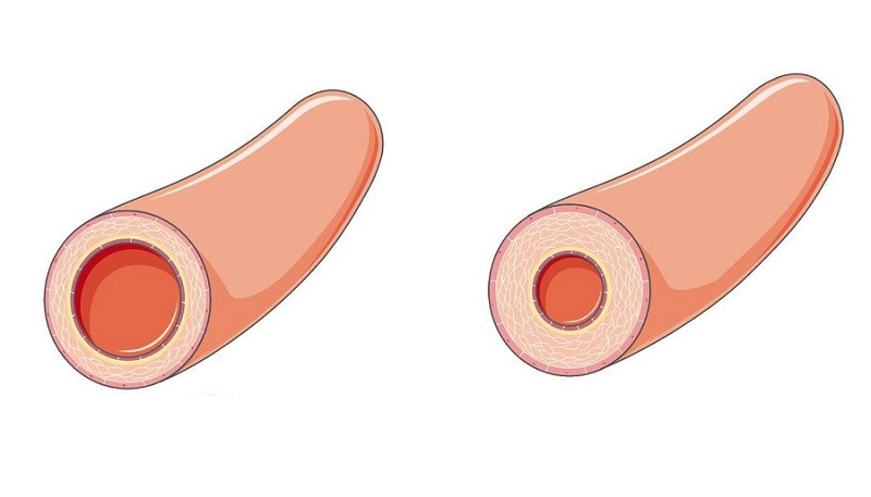 Causes of hypertension