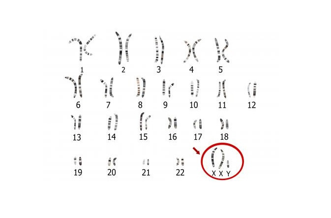 Diagnosis of Klinefelter Syndrome