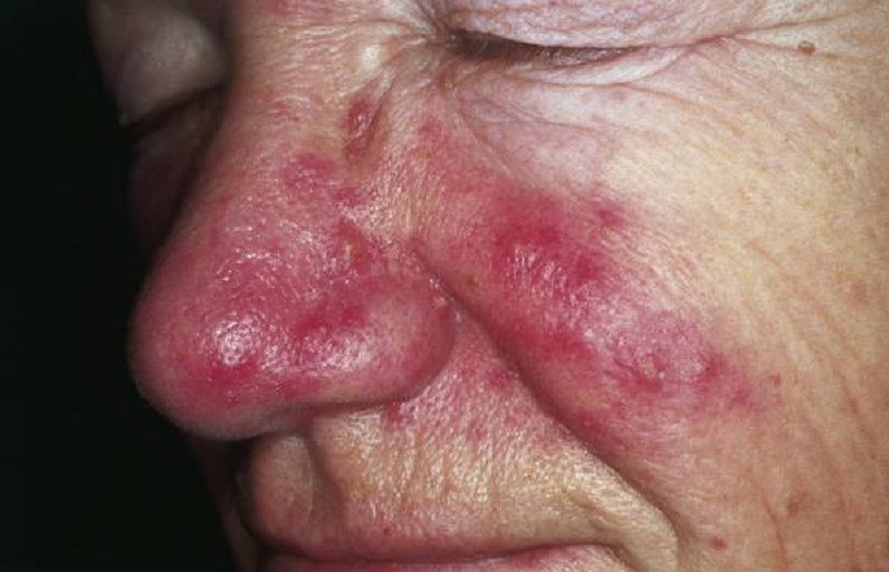 Rosacea