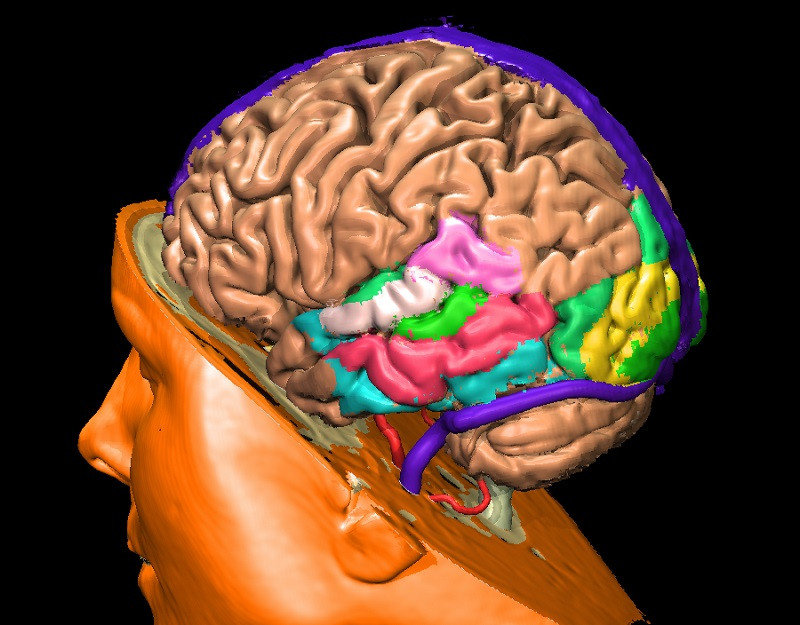Mini stroke