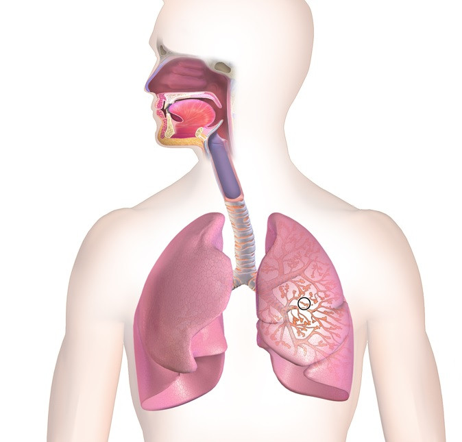 Bronchitis