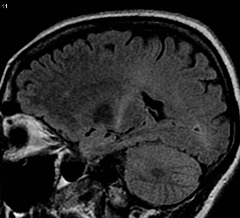 Stages of ALS