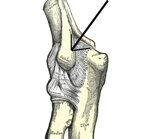 Epicondylitis