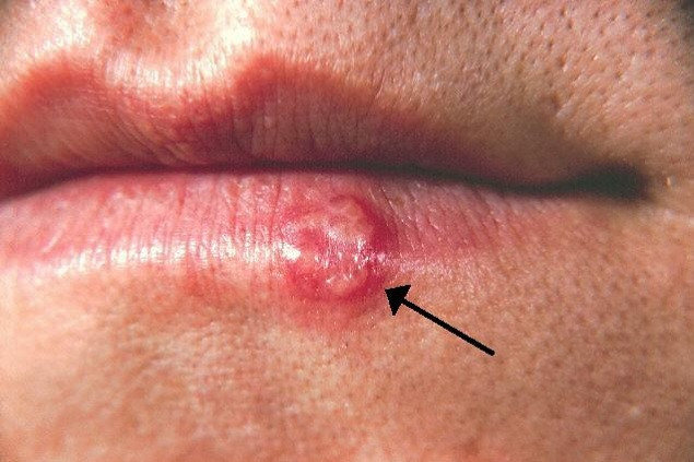 Herpes labialis