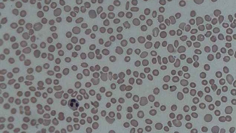 Thrombocytopenia in the blood