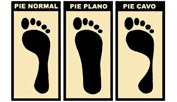 Normal, cavus and flat foot