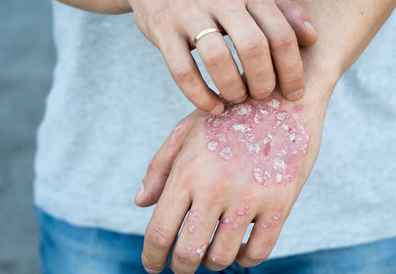 Psoriasis on the skin