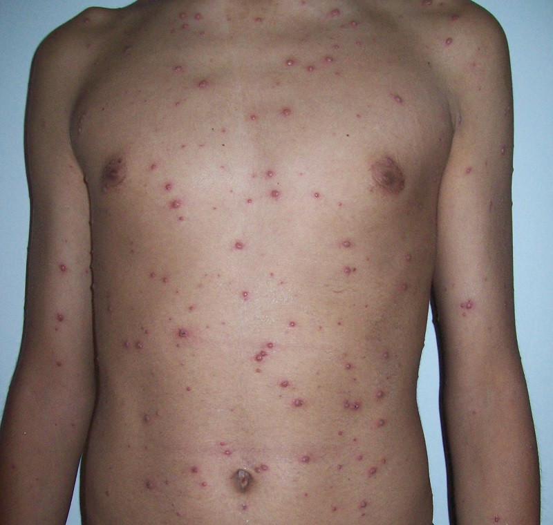 Chickenpox