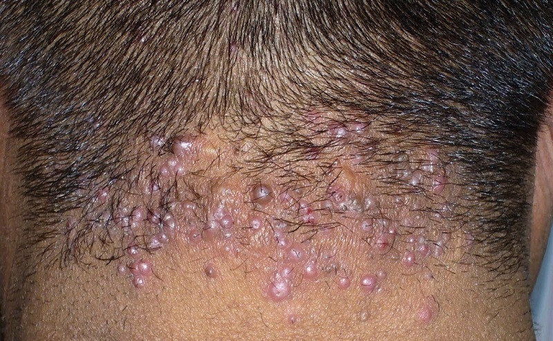 Keloid acne