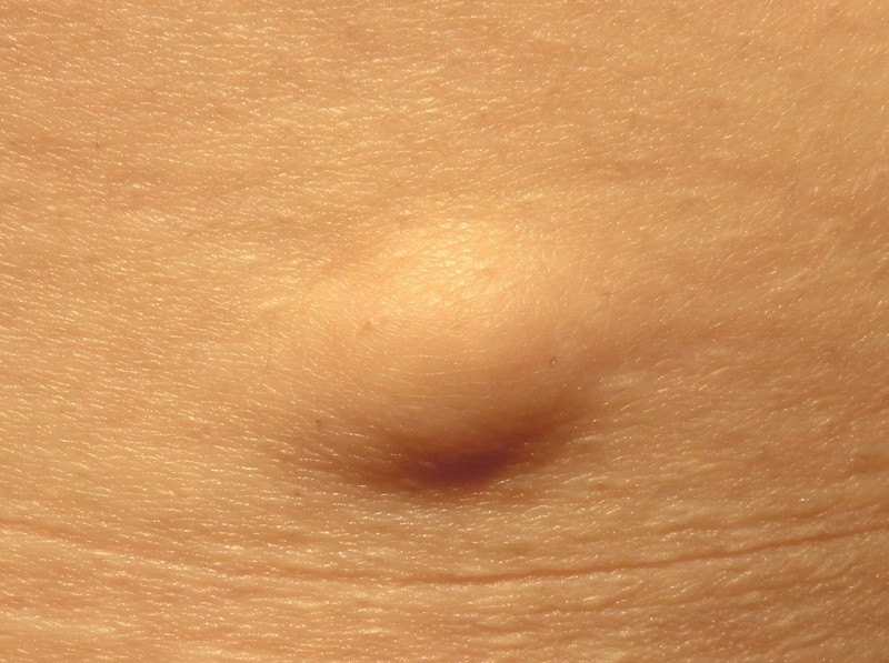 Lipoma