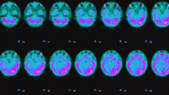 Brain Spect: What it is and How This Neuroimaging Method