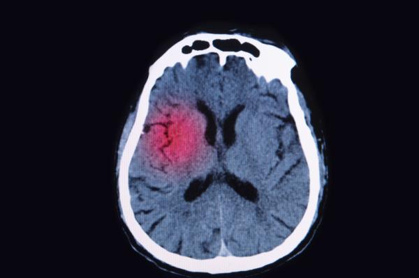 Diseases of the Central Nervous System