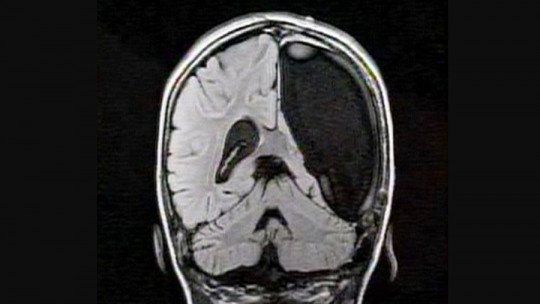 Hemispherectomy: What it Is, and Functions of This Surgical Intervention