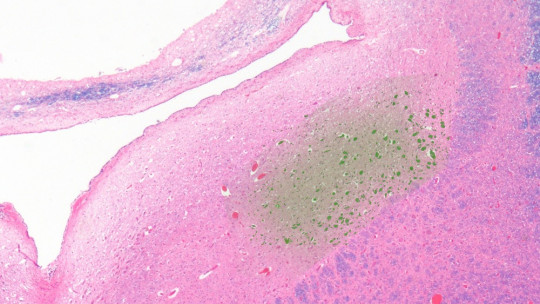 Locus Coeruleus: Its Anatomy, Functions and Diseases