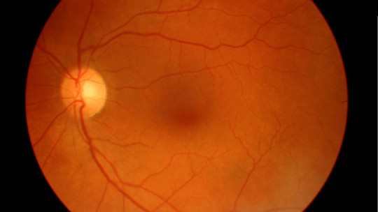 Macular degeneration