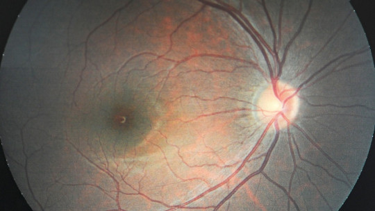 Optic Nerve: Parts, Route and Related Diseases