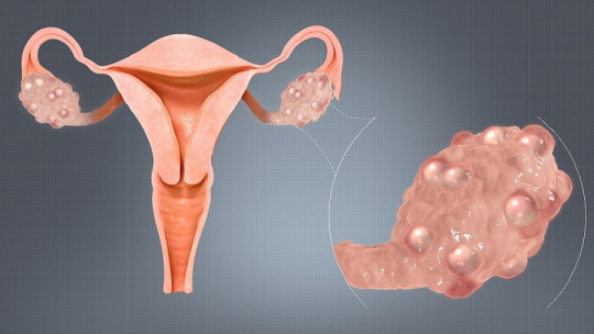 Polycystic ovary syndrome