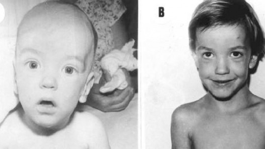 Sotos syndrome