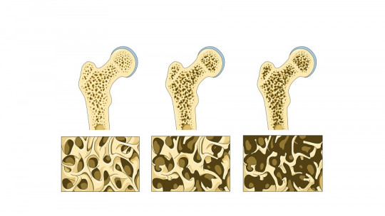 Diseases of the bone system