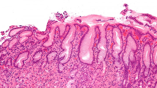 Differences between gastritis and gastroenteritis