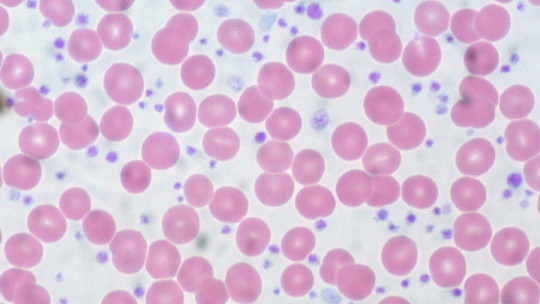 Thrombocytopenia