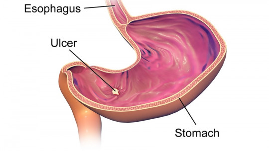 Types of ulcer