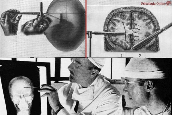 What is lobotomy and what is it for - What is lobotomy