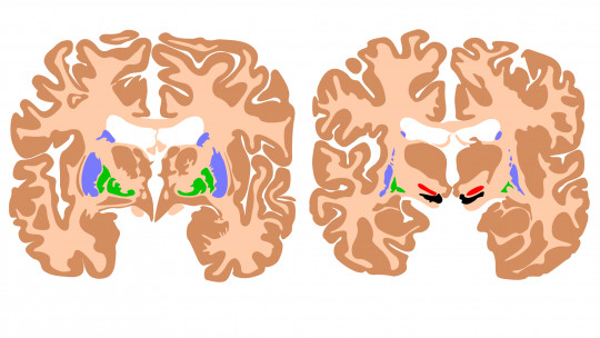 15 Foods That Damage the Health of Our Brain