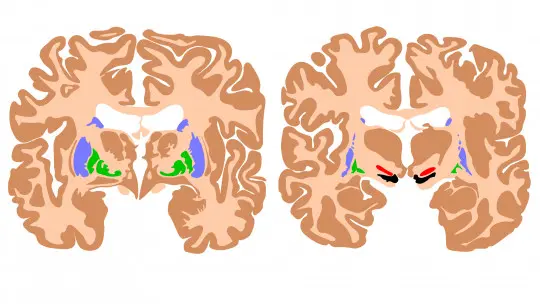 15 foods that damage the health of our brain