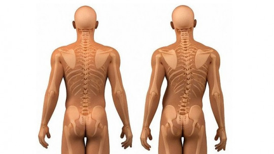 5 Basic Exercises to Prevent and Cure Scoliosis