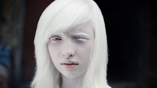 Albino People: Genetics and Problems They Suffer in Different Parts